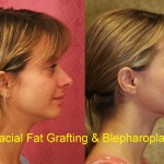 Facial Fat Grafting Before & After Patient #6600