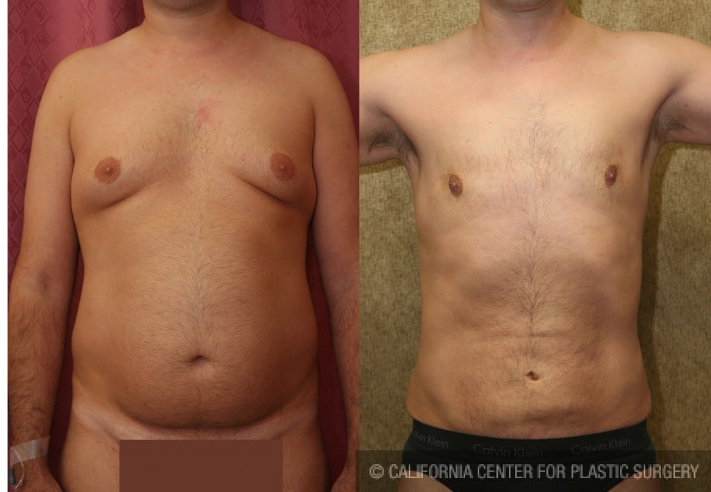 Male gynecomastia (breast) reduction Before & After Patient #6809