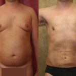 Male gynecomastia (breast) reduction Before & After Patient #6809