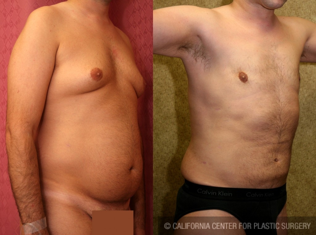 Male gynecomastia (breast) reduction Before & After Patient #6809