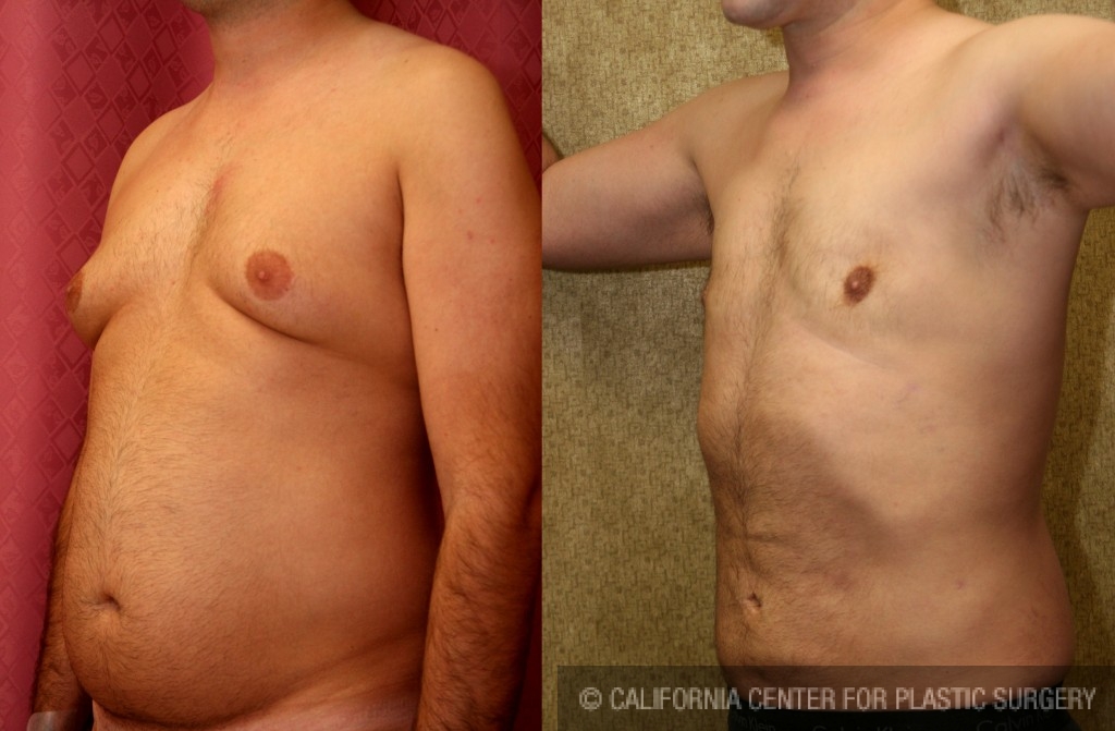 Male gynecomastia (breast) reduction Before & After Patient #6809