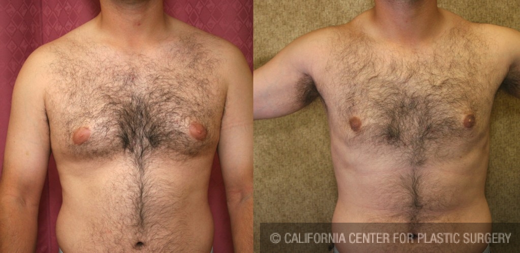 Male gynecomastia (breast) reduction Before & After Patient #6820