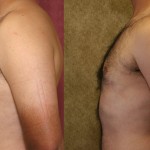 Male gynecomastia (breast) reduction Before & After Patient #6820