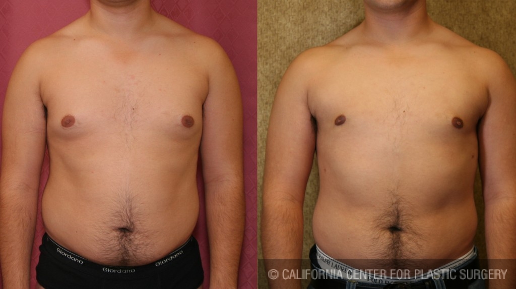 Male gynecomastia (breast) reduction Before & After Patient #6852