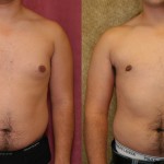 Male gynecomastia (breast) reduction Before & After Patient #6852