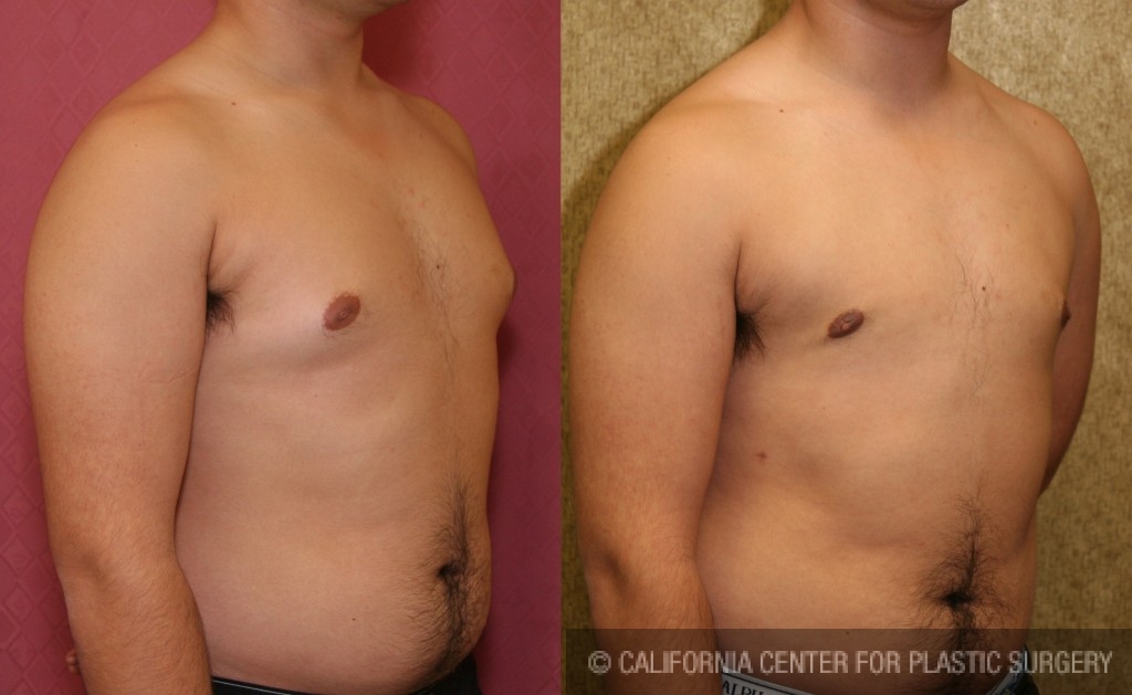 Male gynecomastia (breast) reduction Before & After Patient #6852