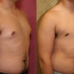 Male gynecomastia (breast) reduction Before & After Patient #6852