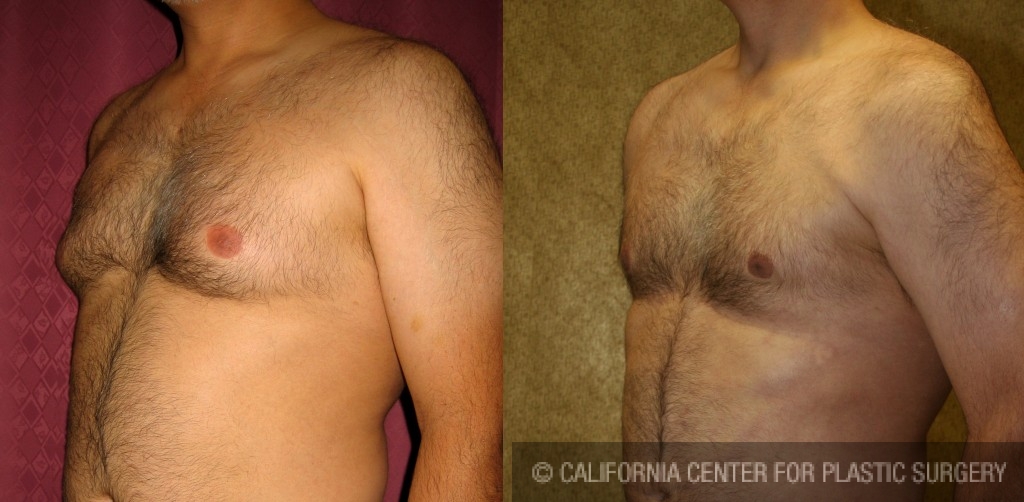 Male gynecomastia (breast) reduction Before & After Patient #6843