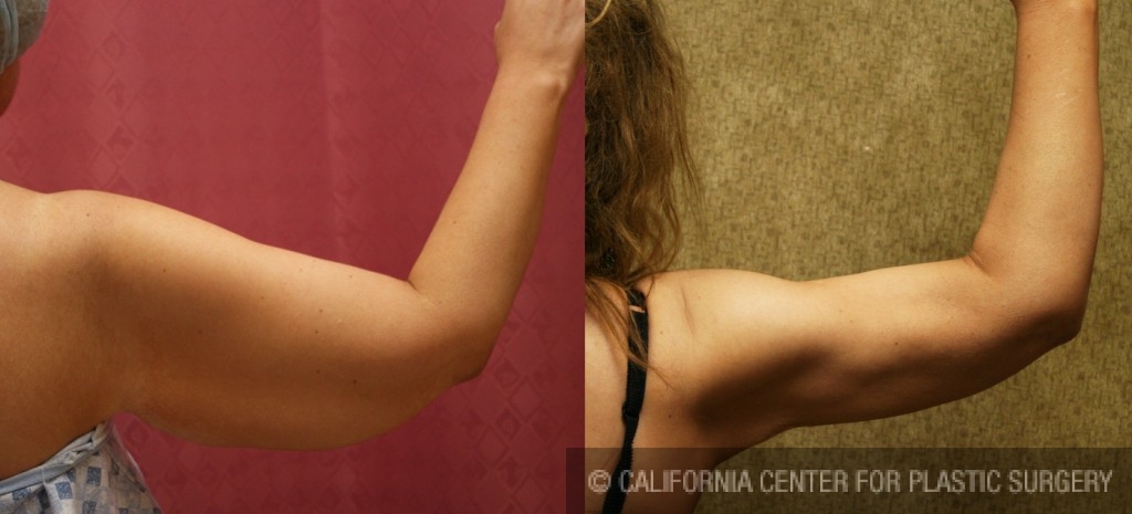 Liposuction Arms Before & After Patient #5702