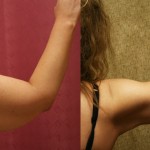 Liposuction Arms Before & After Patient #5702