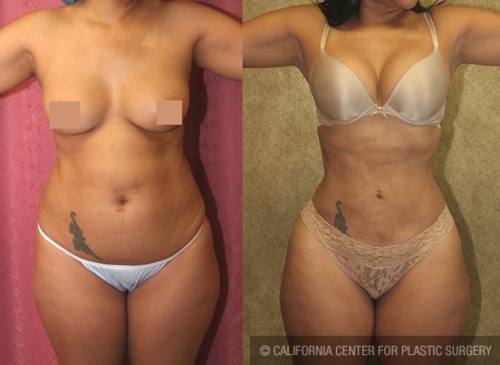 Liposuction Abdomen Medium Before & After Patient #5552