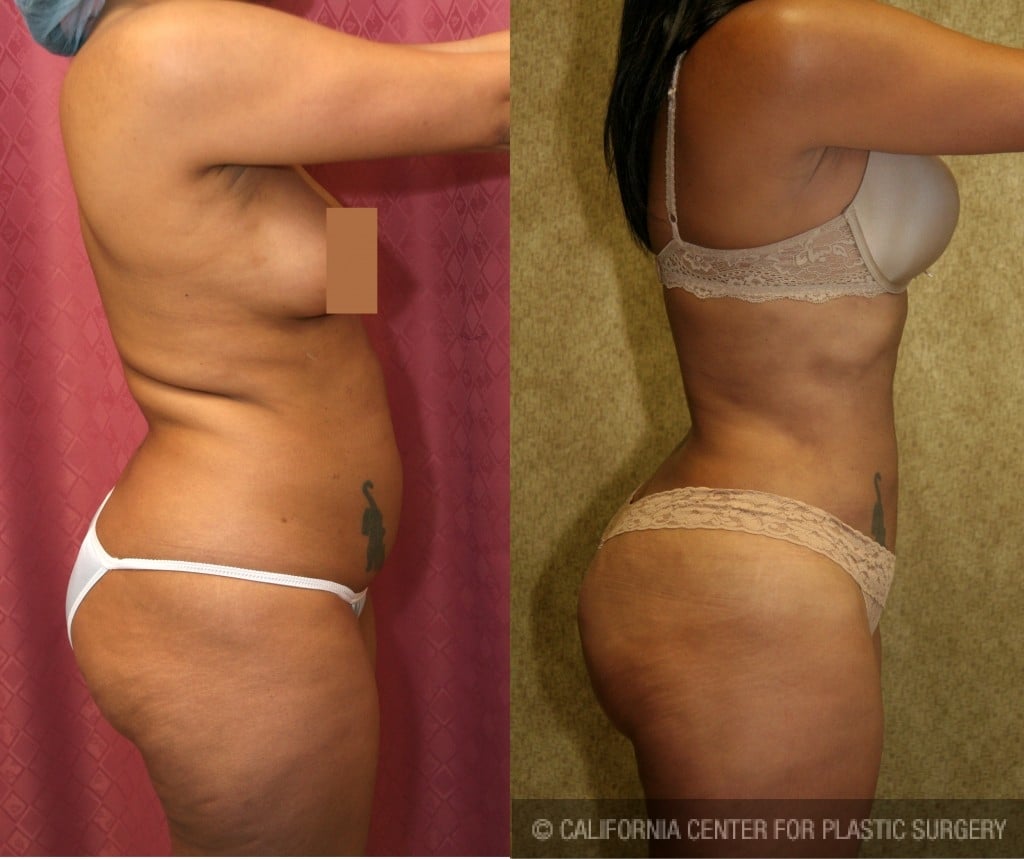 Liposuction Abdomen Medium Before & After Patient #5552