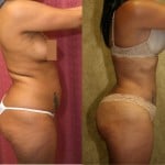 Liposuction Abdomen Medium Before & After Patient #5552