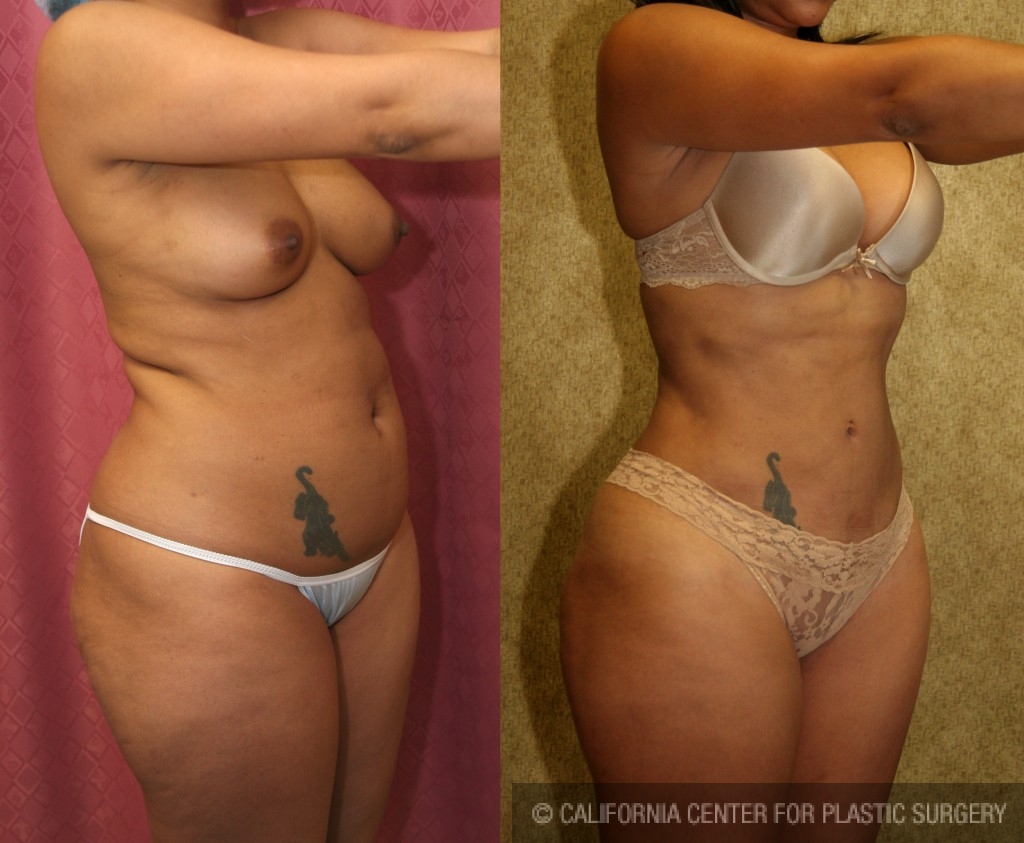 Liposuction Abdomen Medium Before & After Patient #5552