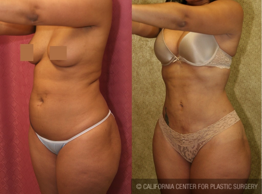 Liposuction Abdomen Medium Before & After Patient #5552