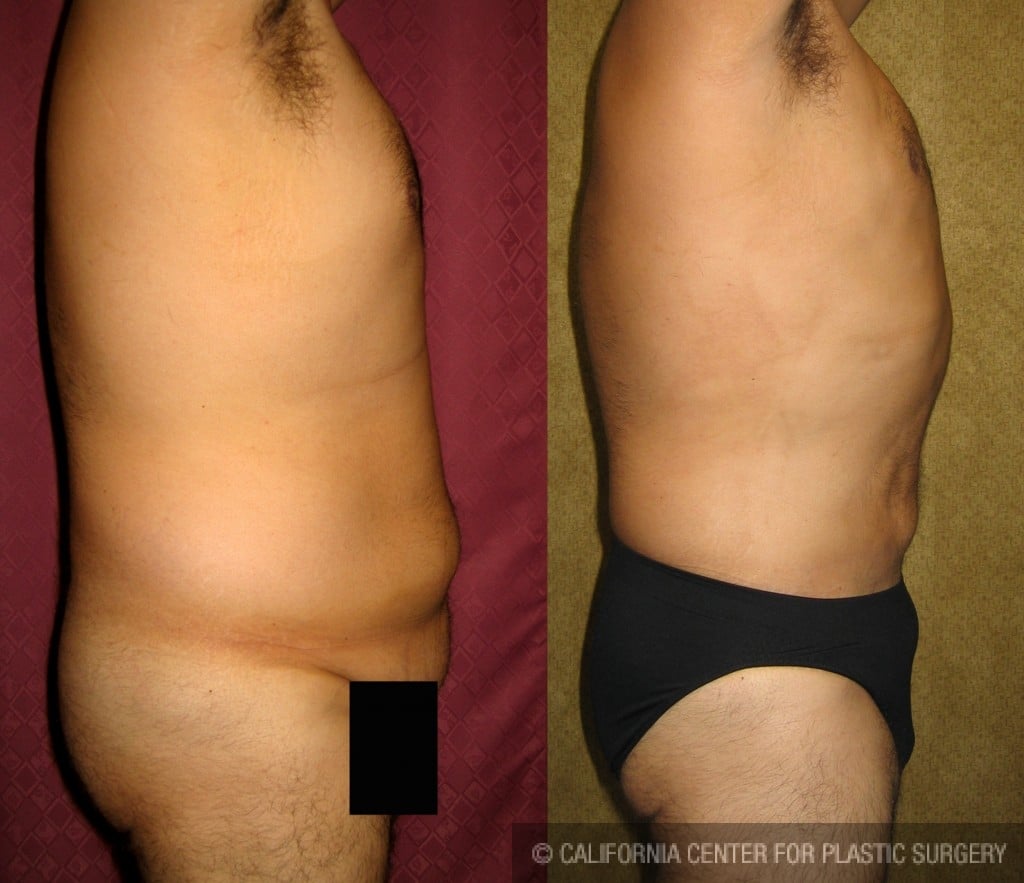 Liposuction for Men Before & After Photos Patient 149