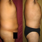 Male Liposuction Abdomen Before & After Patient #5622