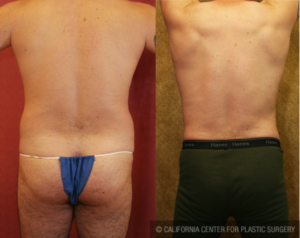 Male Liposuction Abdomen Before & After Patient #5665