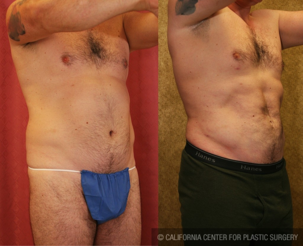 Male Liposuction Abdomen Before & After Patient #5665