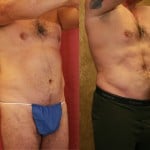 Male Liposuction Abdomen Before & After Patient #5665