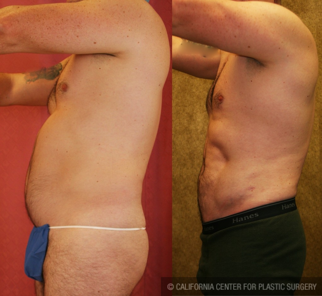 Male Liposuction Abdomen Before & After Patient #5665