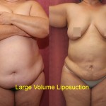 Liposuction Abdomen Plus Size Before & After Patient #5585