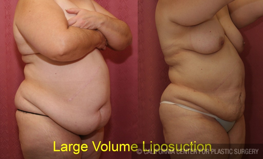 Liposuction Abdomen Plus Size Before & After Patient #5585