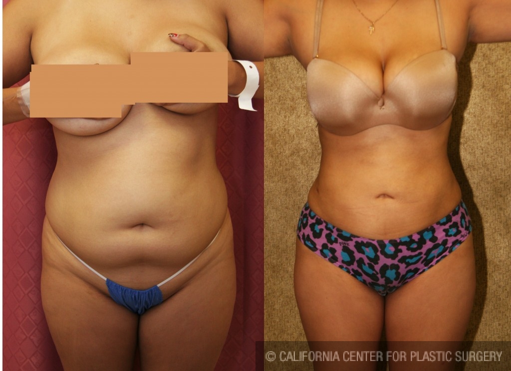 Liposuction Abdomen Medium Before & After Patient #5544