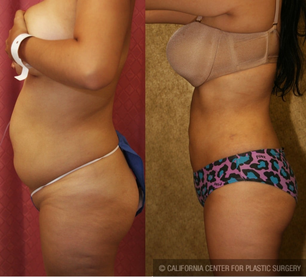 Liposuction Abdomen Medium Before & After Patient #5544