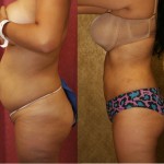 Liposuction Abdomen Medium Before & After Patient #5544