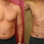 Male Liposuction Abdomen Before & After Patient #5646