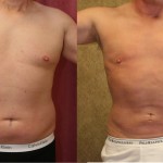 Male Liposuction Abdomen Before & After Patient #5651