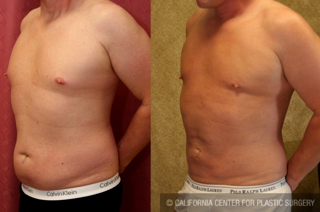 Male Liposuction Abdomen Before & After Patient #5651