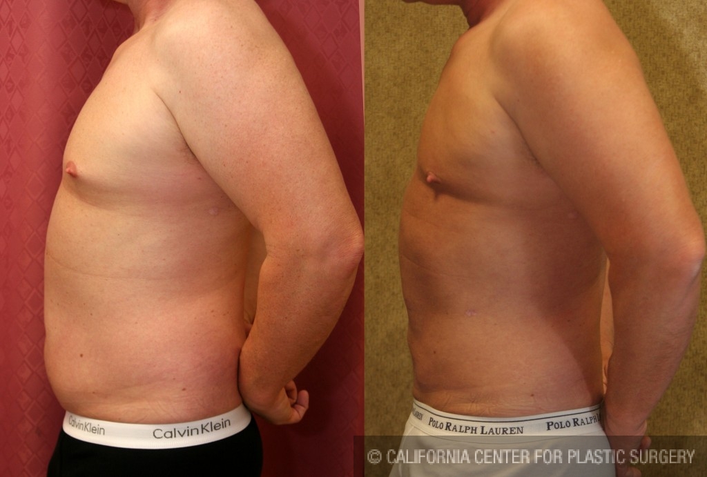 Male Liposuction Abdomen Before & After Patient #5651