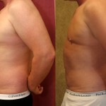 Male Liposuction Abdomen Before & After Patient #5651