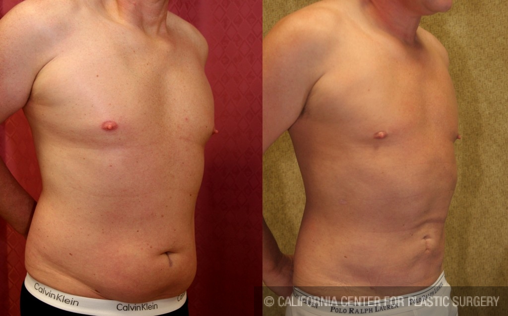 Male Liposuction Abdomen Before & After Patient #5651