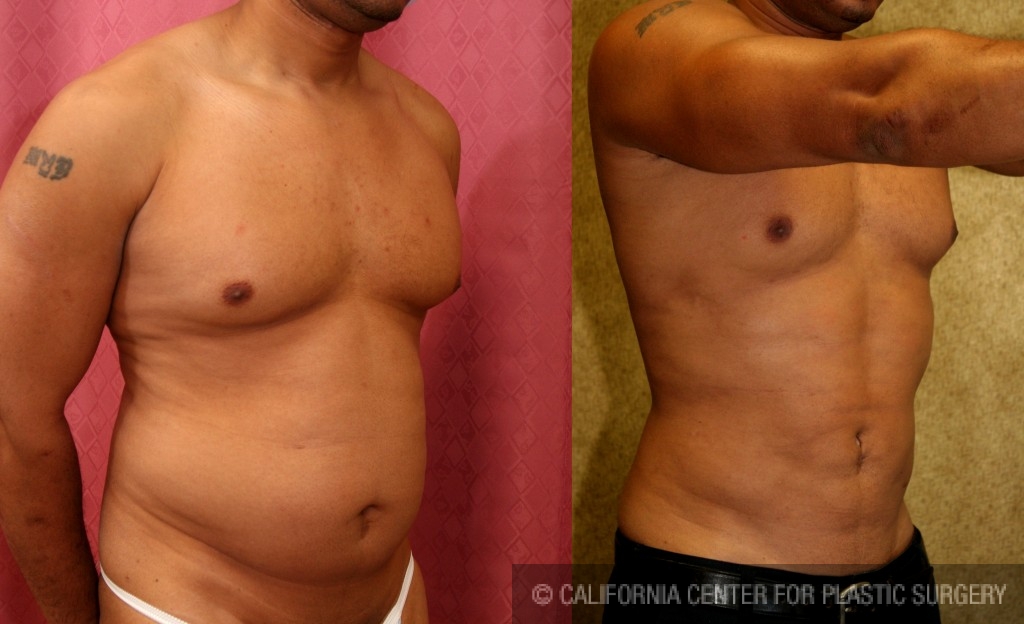 Tummy Tuck and Liposuction on Male Weight Loss Patient