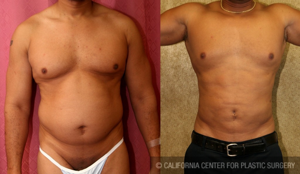 Male Liposuction Abdomen Before & After Patient #5656