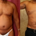 Male Liposuction Abdomen Before & After Patient #5656