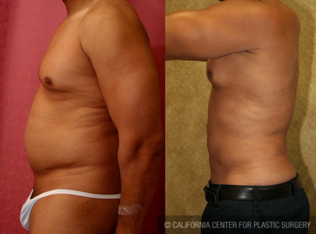 Male Liposuction Abdomen Before & After Patient #5656
