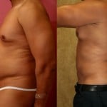 Male Liposuction Abdomen Before & After Patient #5656