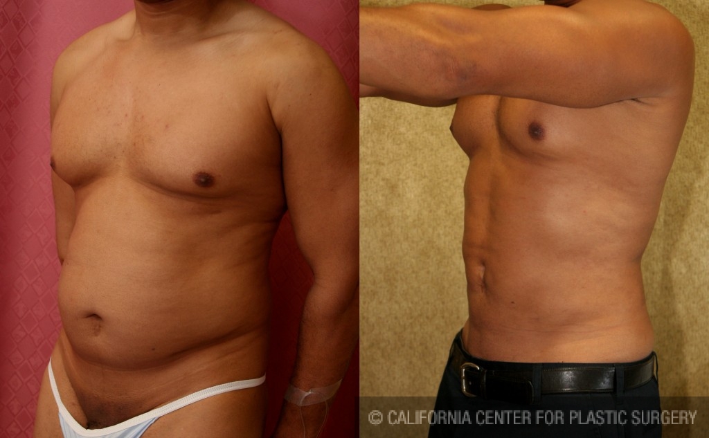 Male Liposuction Abdomen Before & After Patient #5656