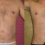 Male Liposuction Abdomen Before & After Patient #5629