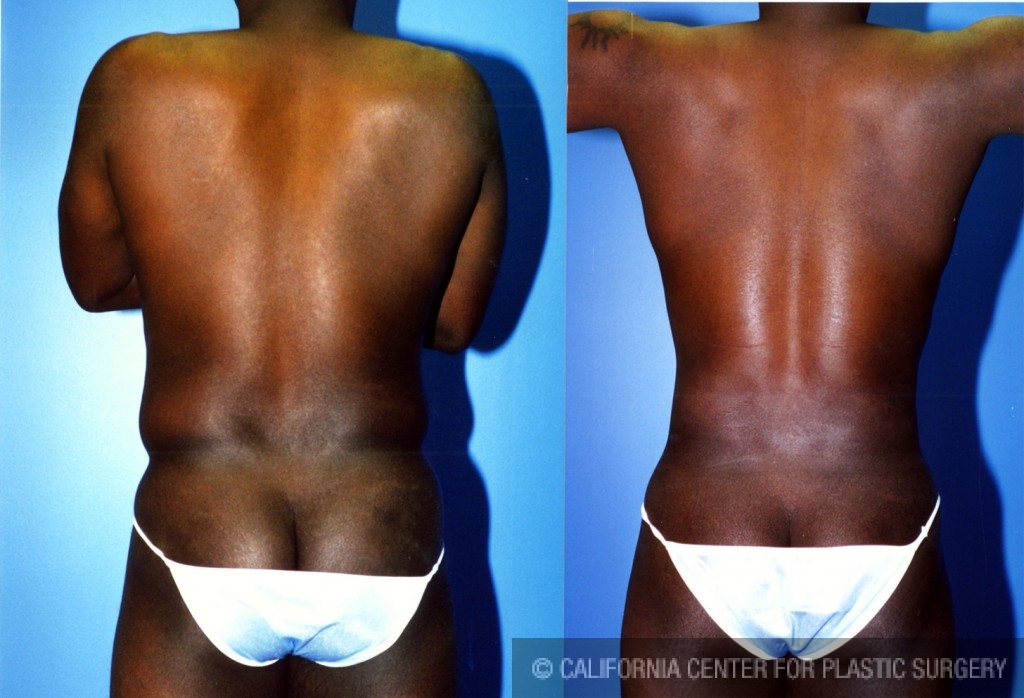 Male Liposuction Abdomen Before & After Patient #5638