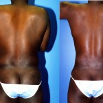 Male Liposuction Abdomen Before & After Patient #5638