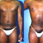 Male Liposuction Abdomen Before & After Patient #5638