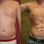 Male Liposuction Abdomen Before & After Patient #5600