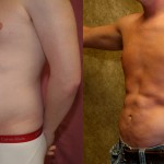 Male Liposuction Abdomen Before & After Patient #5600