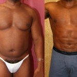 Male Liposuction Abdomen Before & After Patient #5661