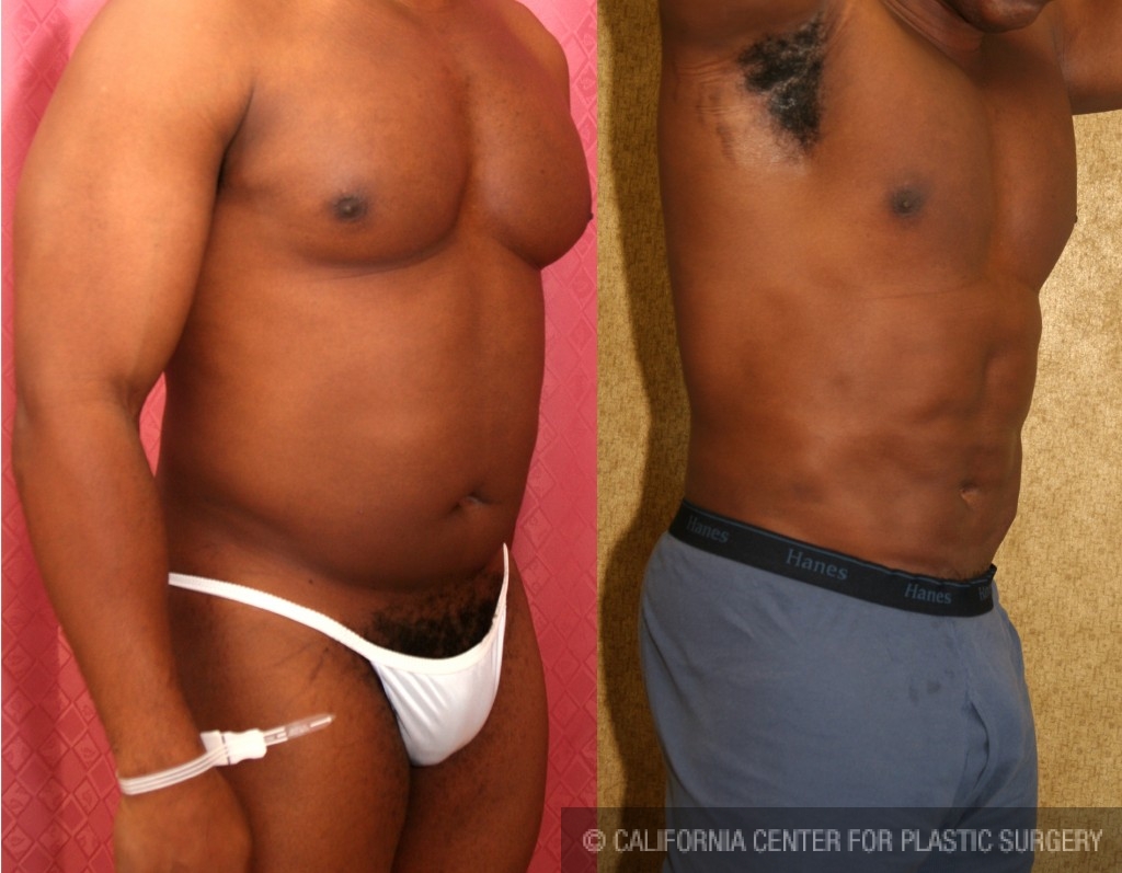 Male Liposuction Abdomen Before & After Patient #5661